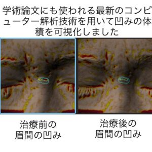 眉間に出来たニキビ跡の凹みに対する幹細胞治療