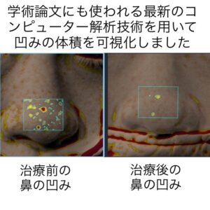 鼻に出来たニキビ跡の凹みに対する幹細胞治療
