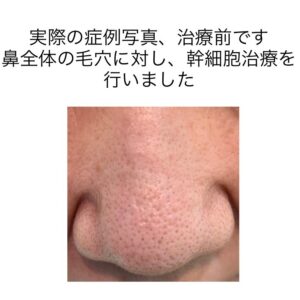 鼻の毛穴に対する幹細胞治療